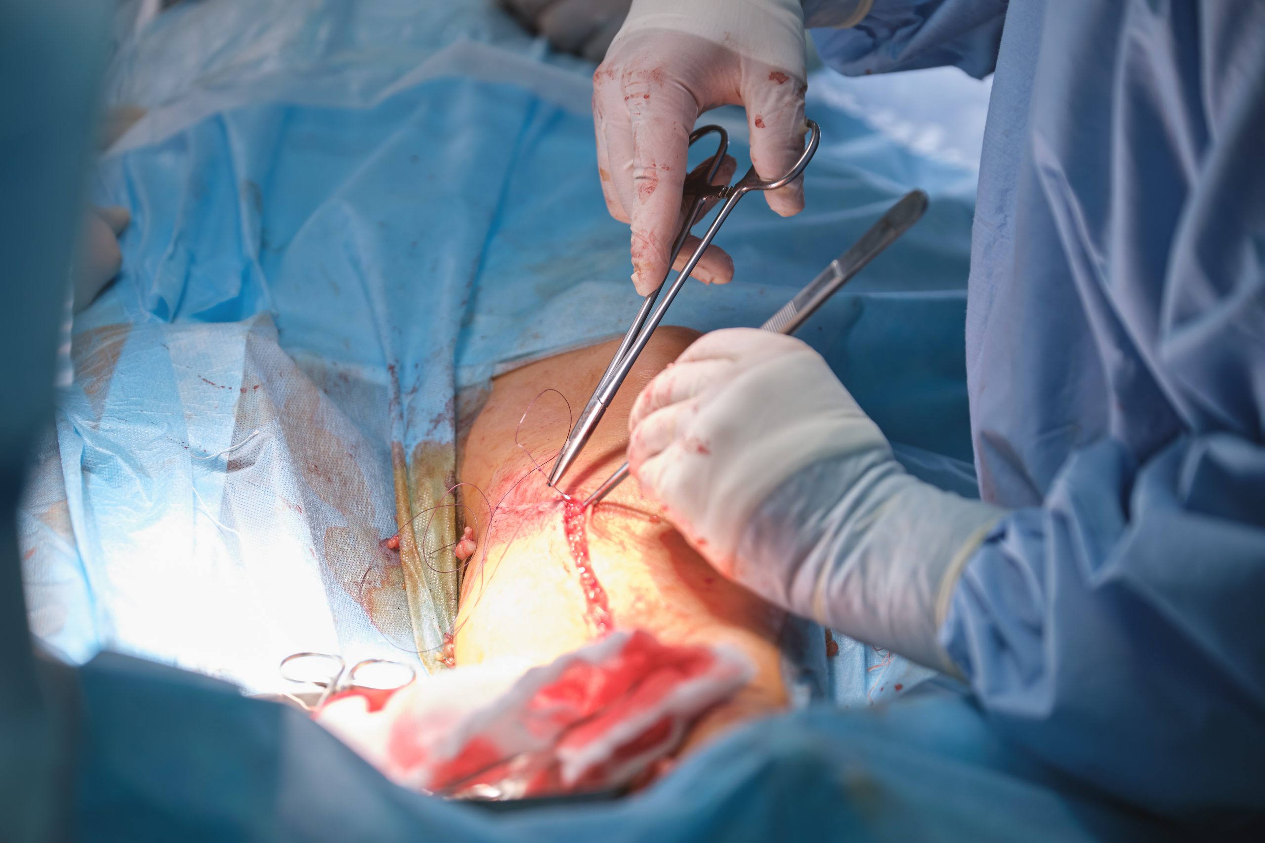Hernioplasty