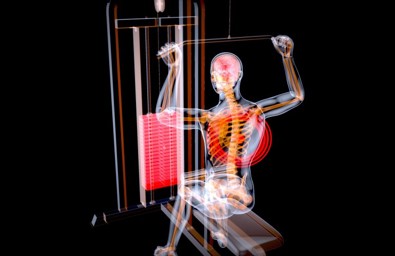 Spinal Fusion